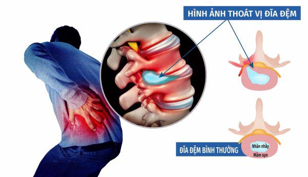 tam-cham-chua-thoat-vi-dia-dem-lung
